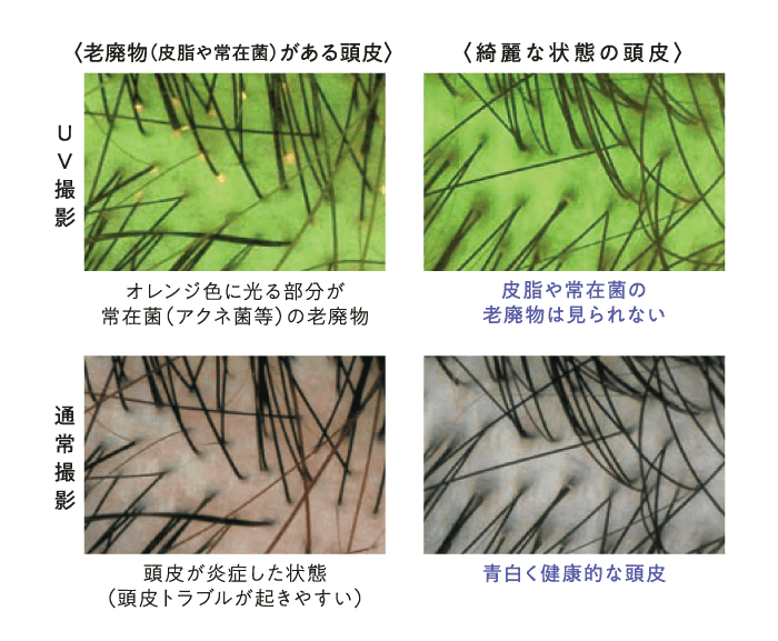 老廃物（皮脂や常在菌）がある頭皮、綺麗な状態の頭皮